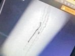 Hasil rontgen pasien dengan kawat tertinggal di jantung